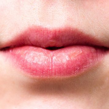 Spierzchnięte usta –  domowe sposoby na suche usta