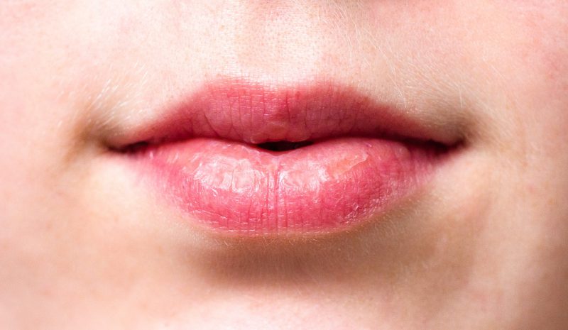 Spierzchnięte usta –  domowe sposoby na suche usta